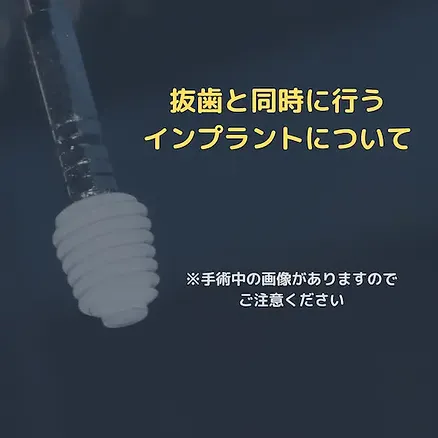抜歯即時埋入インプラント