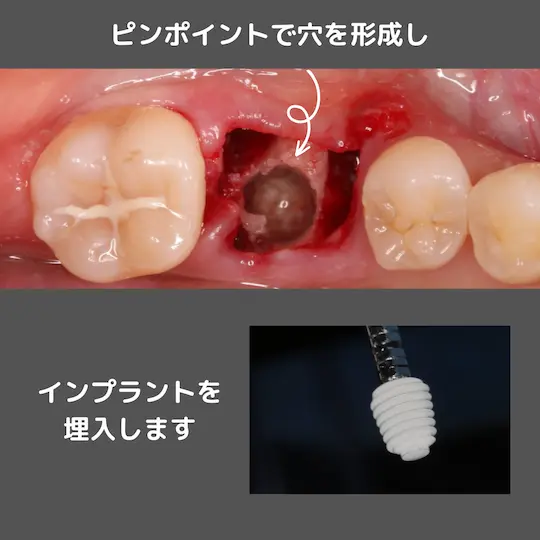 抜歯と感染巣の除去