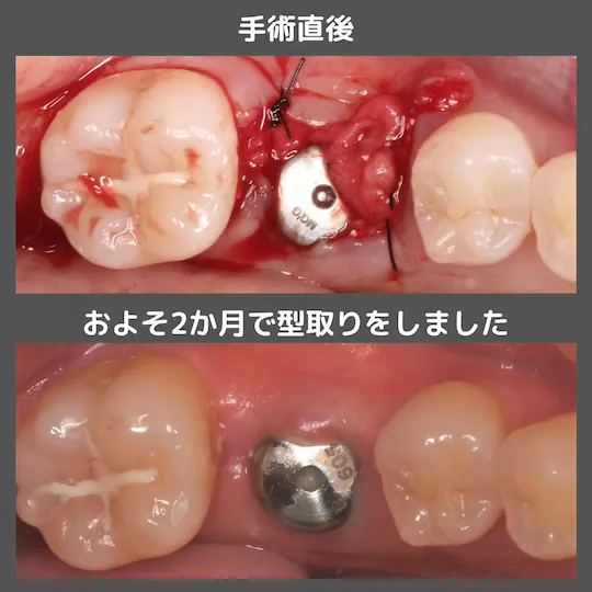 インプラント埋入窩の形成