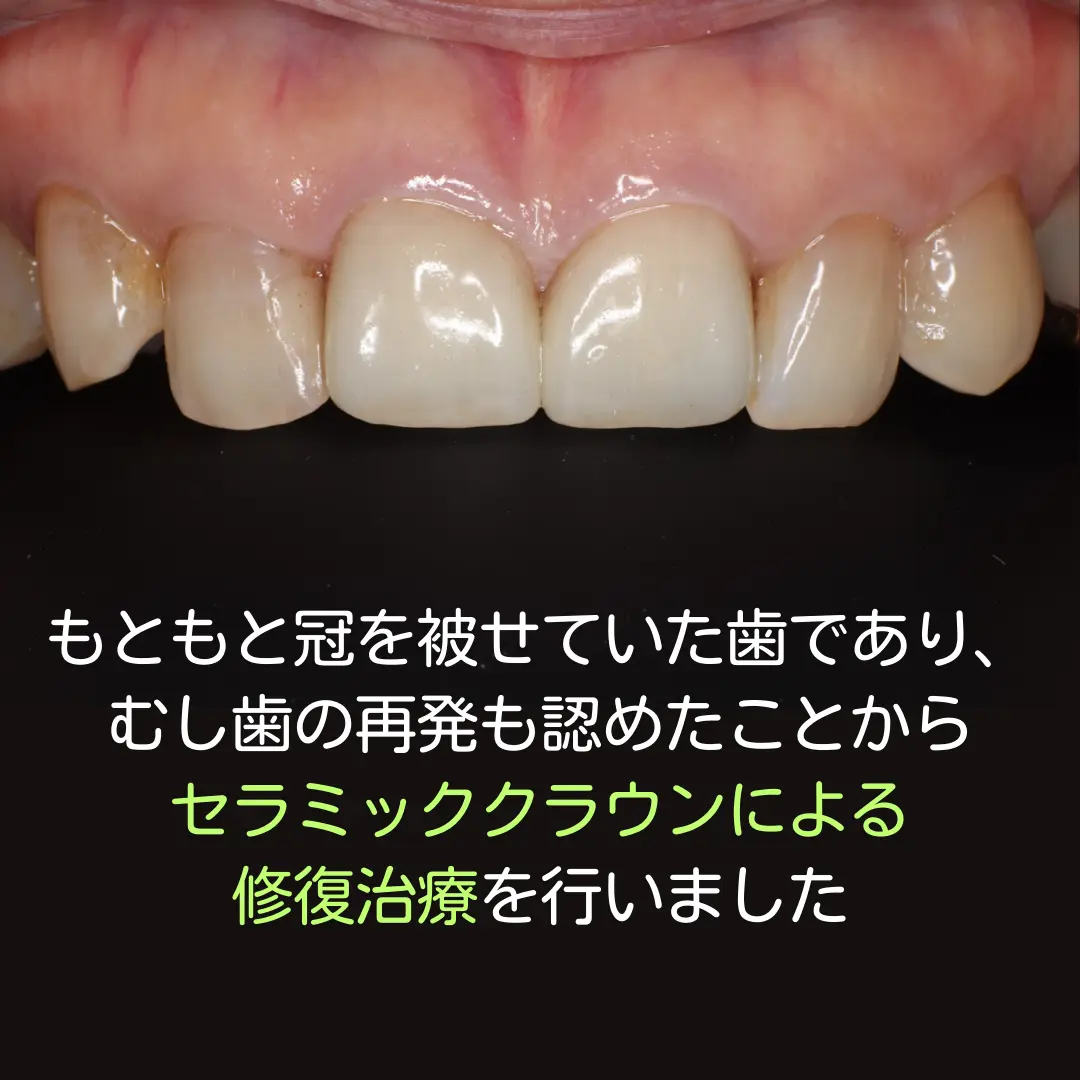 ジルコニアクラウン治療前