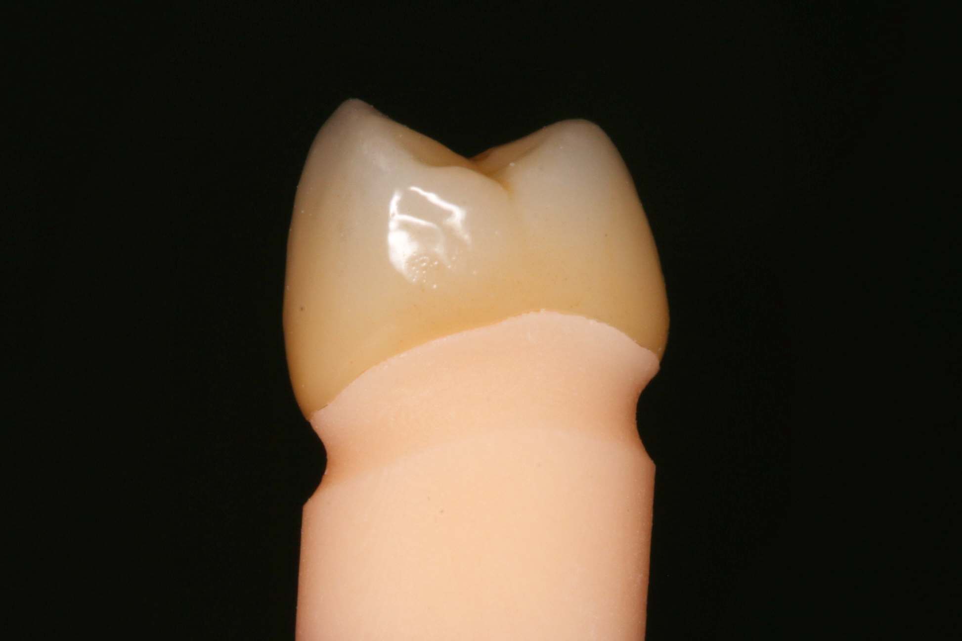 クラウンの適合精度