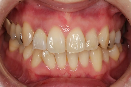 前歯のセラミック治療 術後