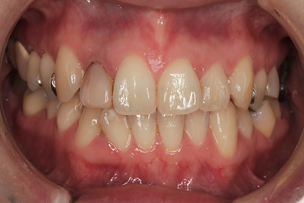 前歯のセラミック治療 術前