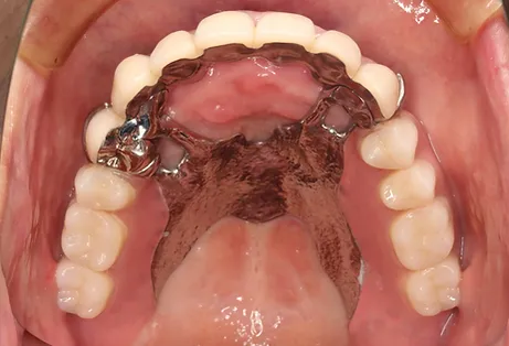 金属床義歯 術後