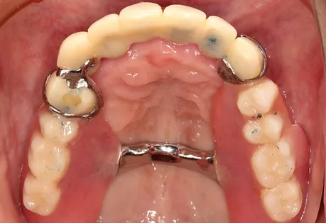 金属床義歯 術前