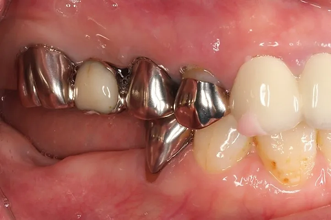 インプラント治療 術前