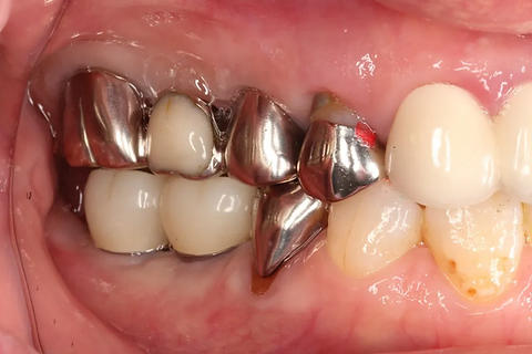 インプラント治療 術後