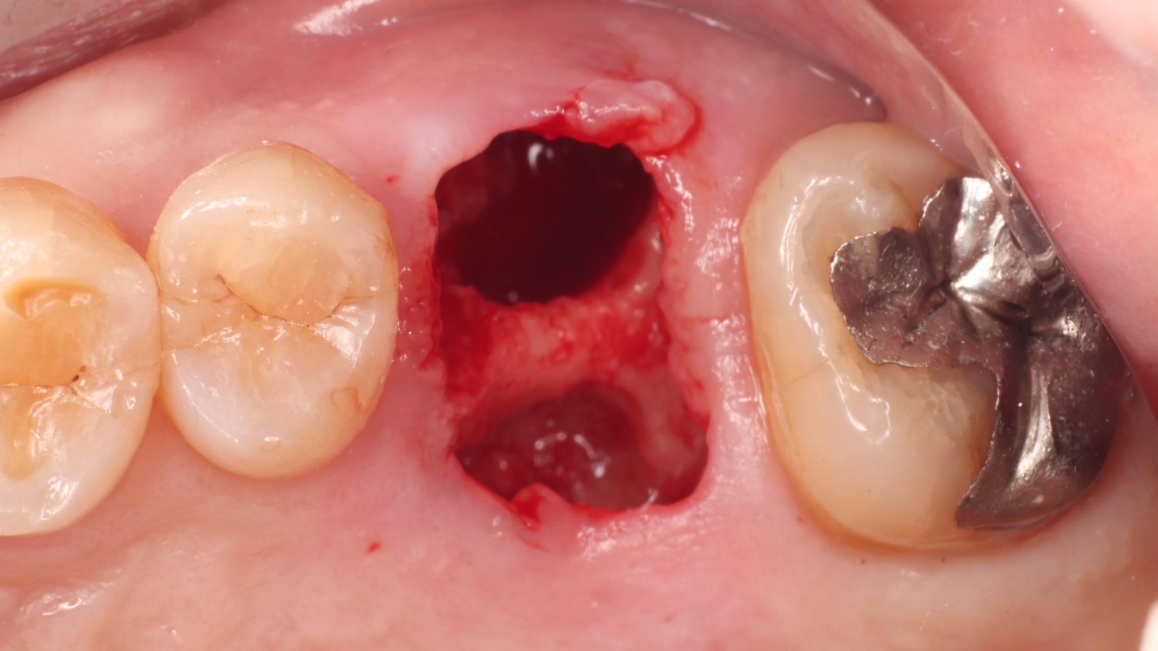 抜歯直後の抜歯窩
