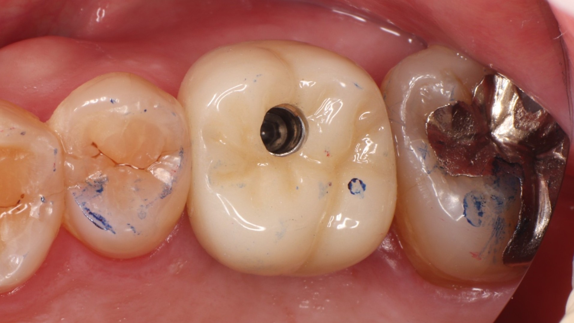 最終クラウン装着後