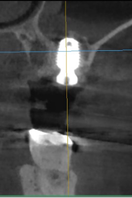 インプラント埋入直後のCT