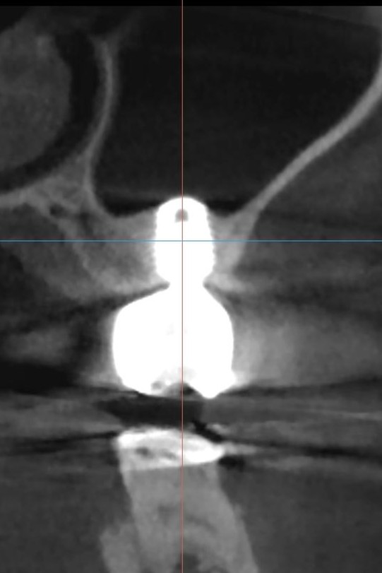 術後3年フォローアップCT