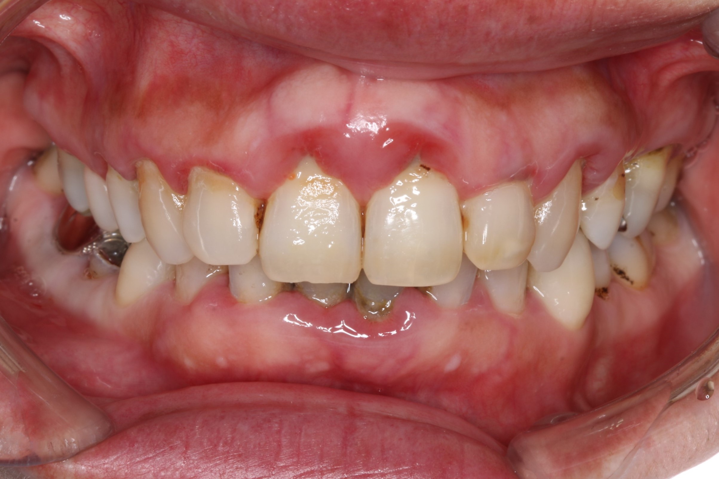 歯周病治療 術前写真