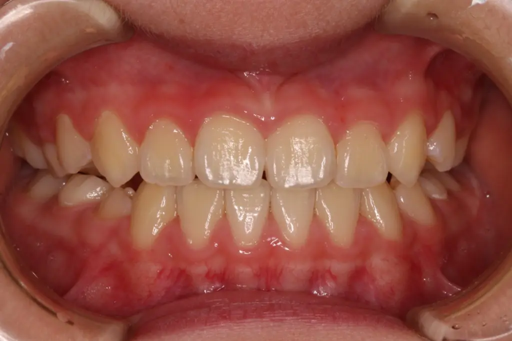 プレオルソ治療3年後