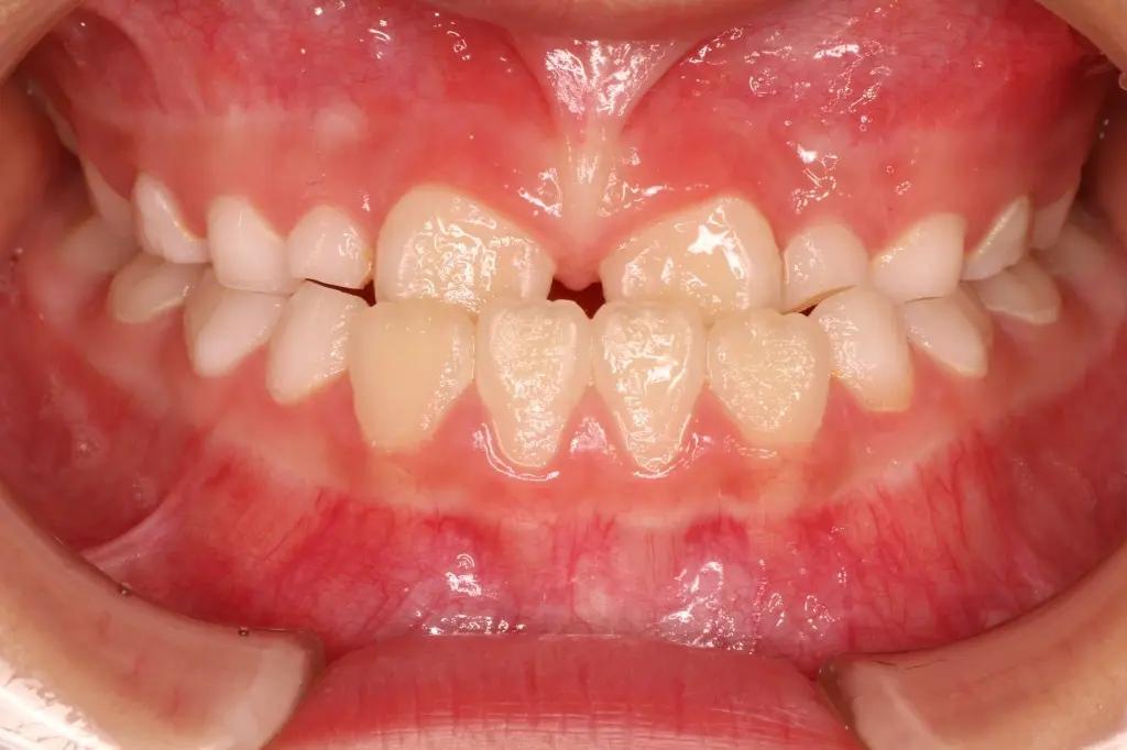 プレオルソ治療前の状態